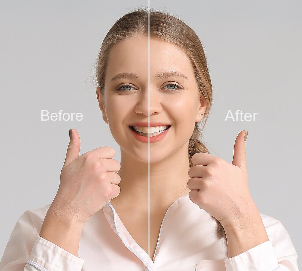 Comparing smile makeover before and after