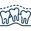 Replacing several teeth with implants