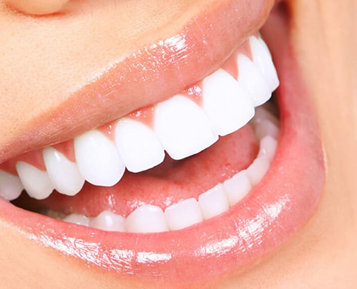 Improving smiles with porcelain veneers in Conway SC
